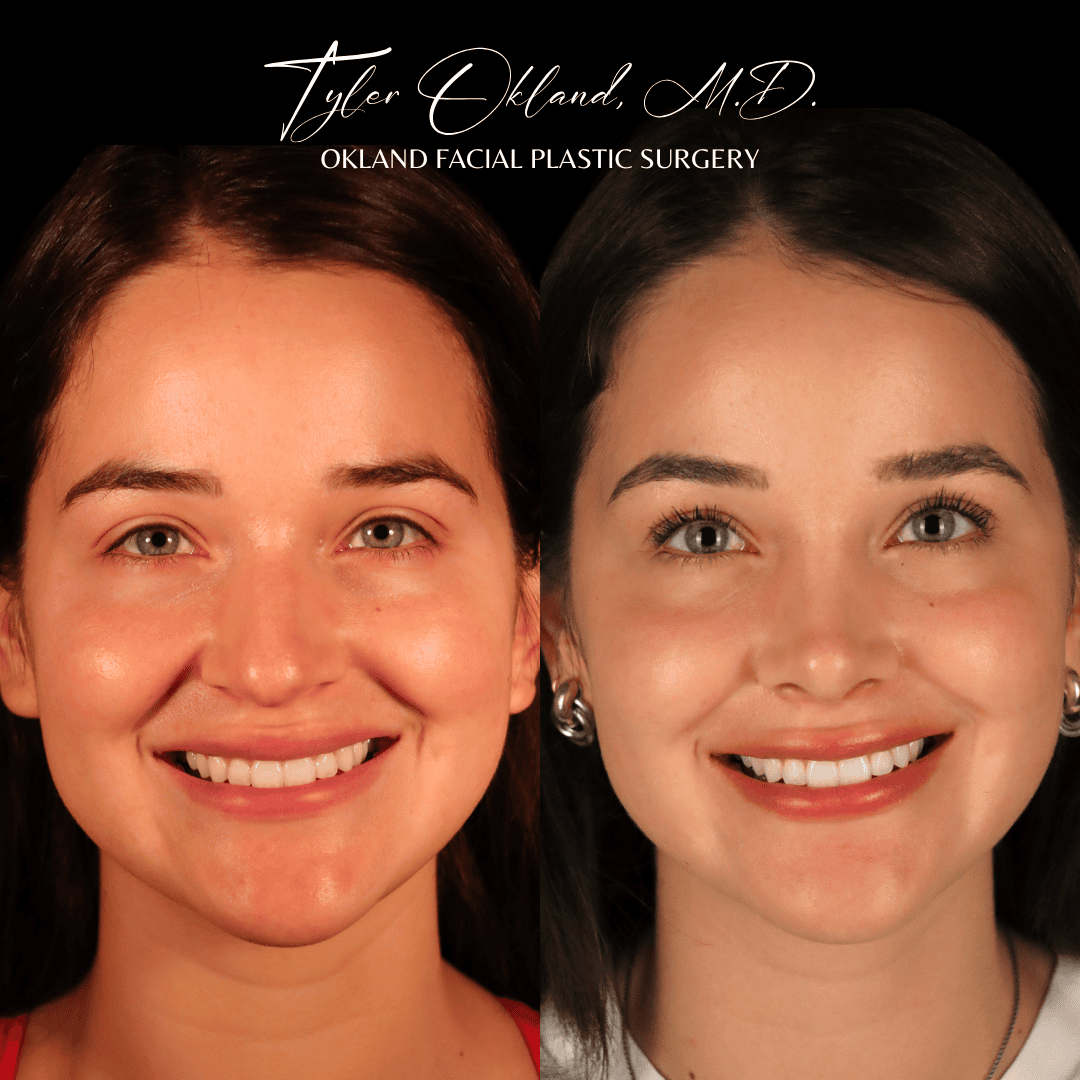 Primary rhinoplasty before and after case 1 by Dr. Tyler Okland