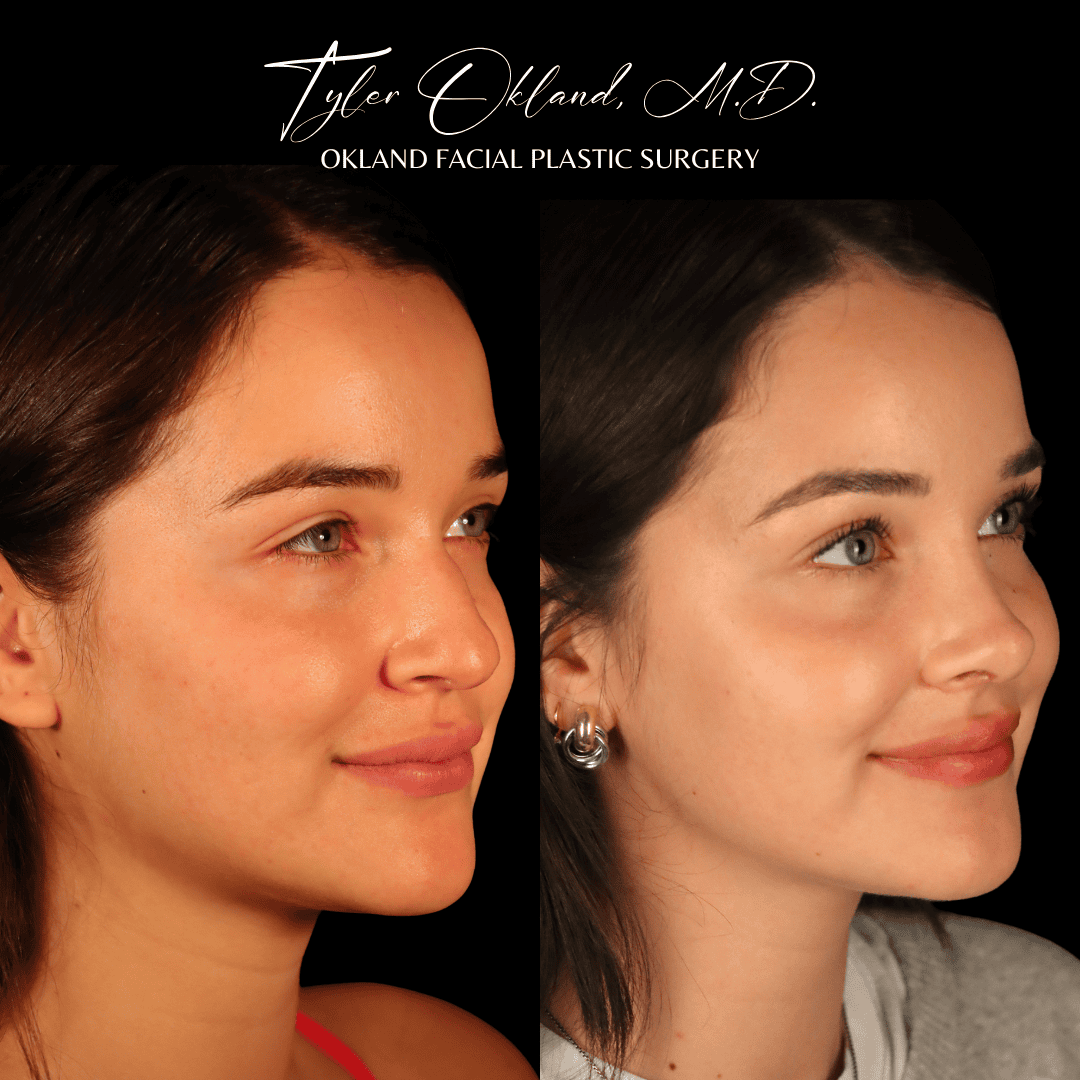 Primary rhinoplasty patient result by Dr. Tyler Okland in Denver