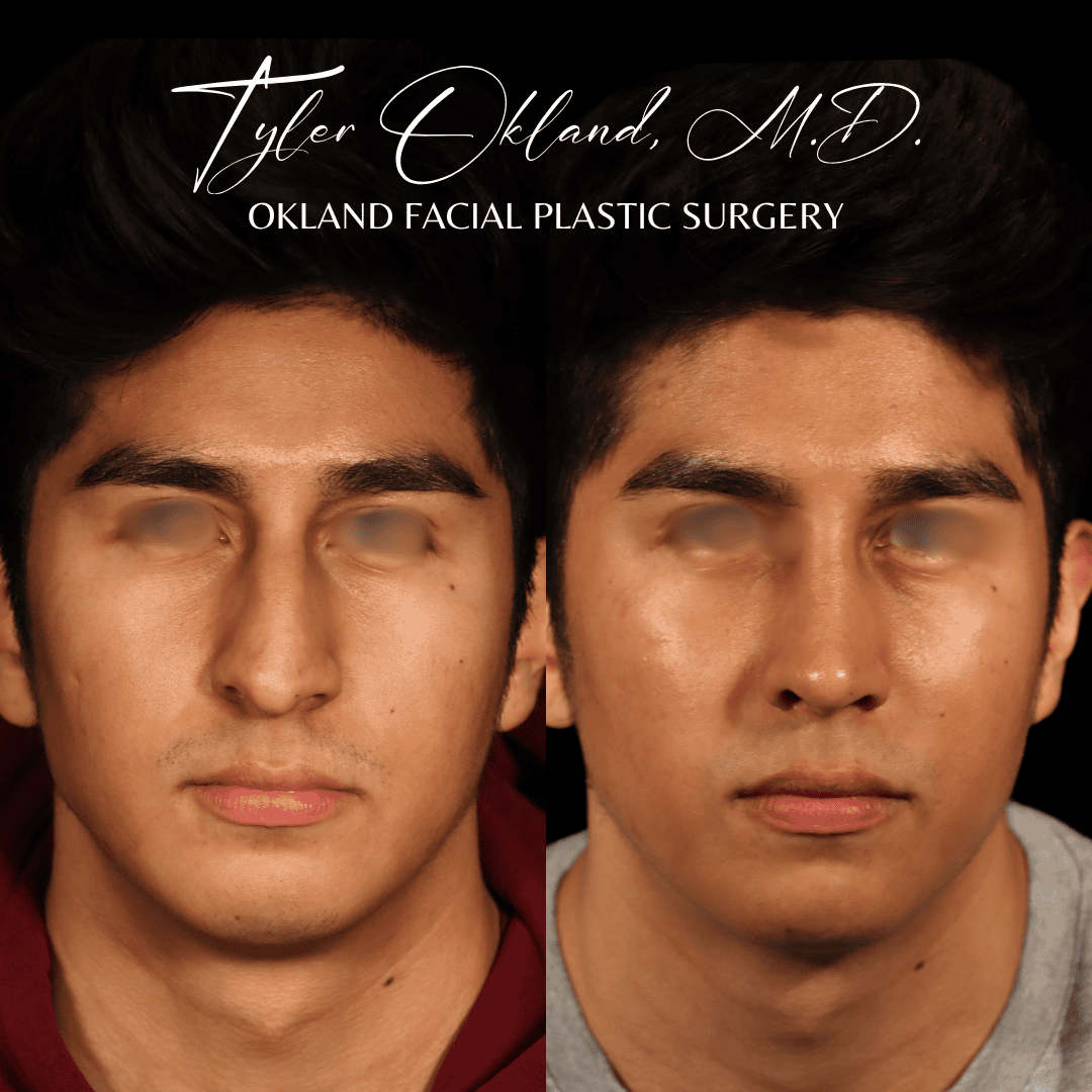 CASE 04 featured rhinoplasty result
