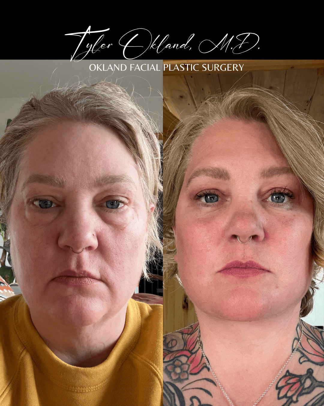 Frontal progress photographs submitted by an out-of-state facelift patient.