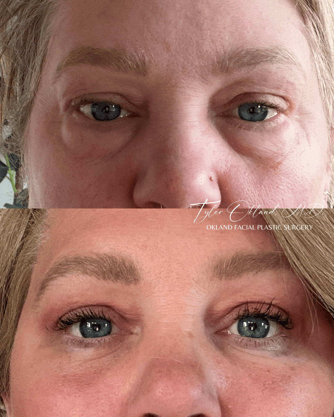 Eye-area progress photographs submitted by an out-of-state facelift patient.