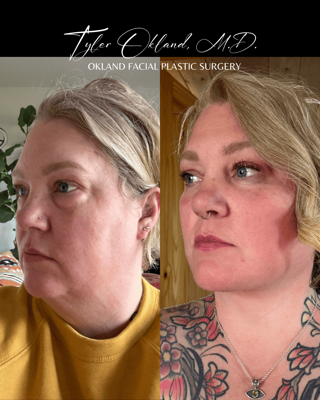 Three-quarter progress photographs submitted by an out-of-state facelift patient.