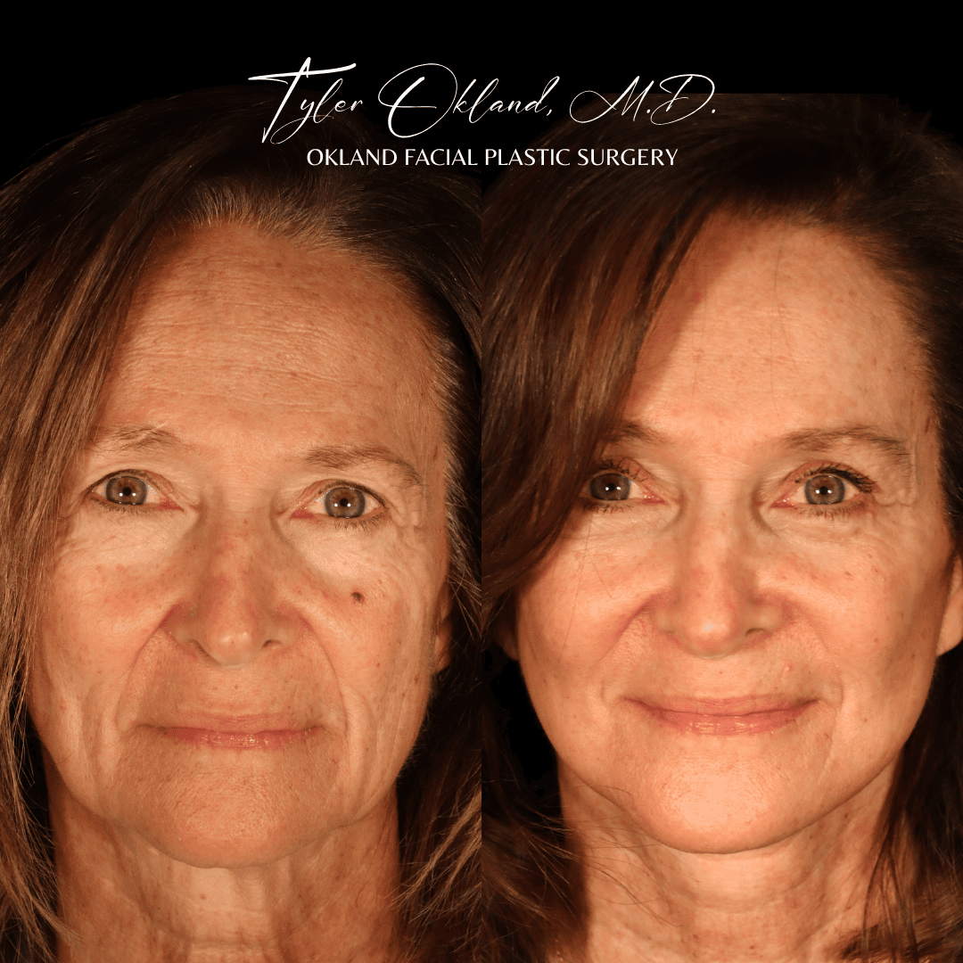 Deep plane facelift before and after front view by Dr. Tyler Okland in Denver