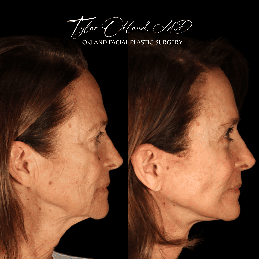 Deep plane facelift before and after profile view by Dr. Tyler Okland in Denver