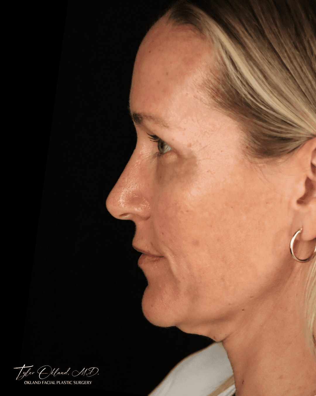 Before view of a facelift patient from the left profile.