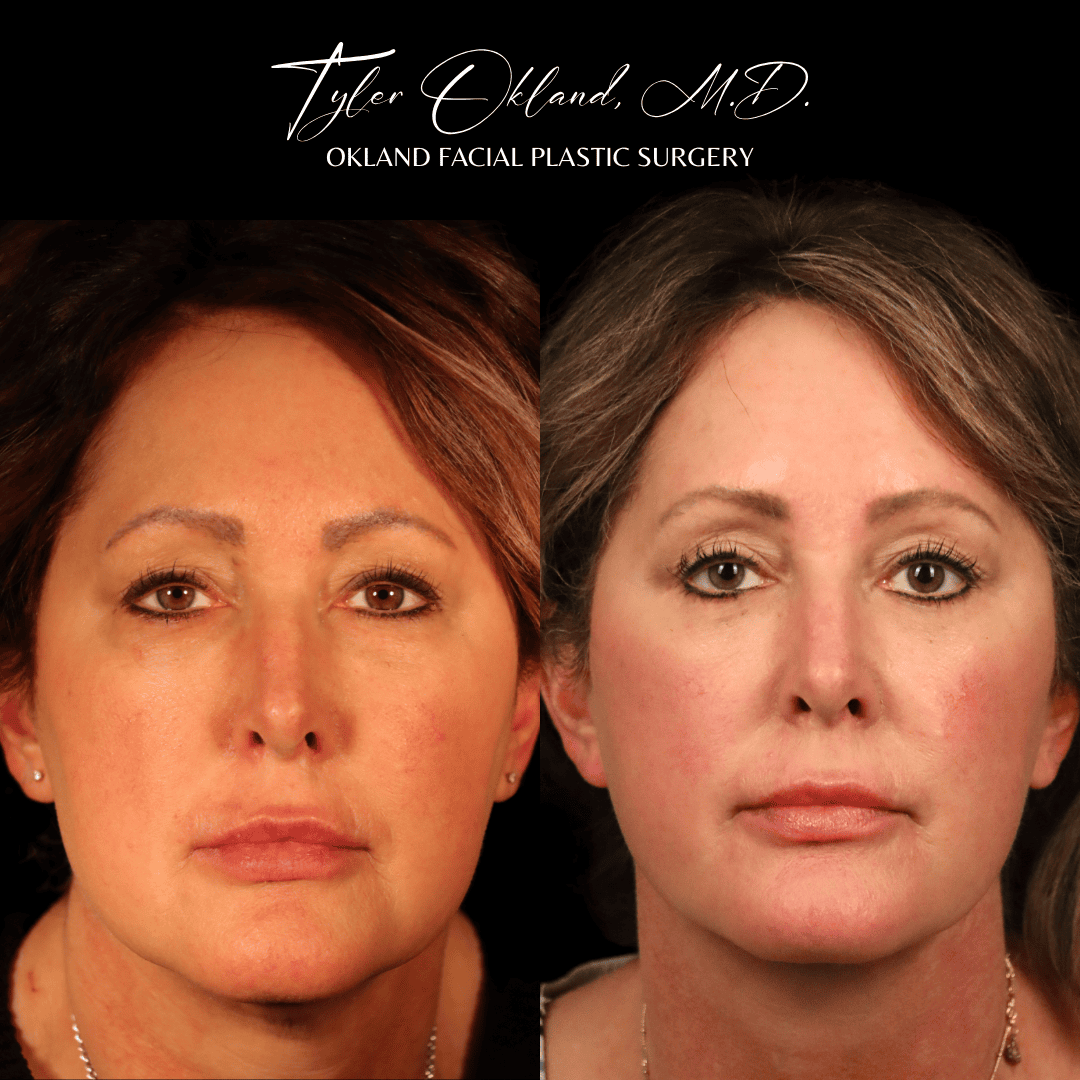 Frontal before-and-after result after comprehensive facial rejuvenation.