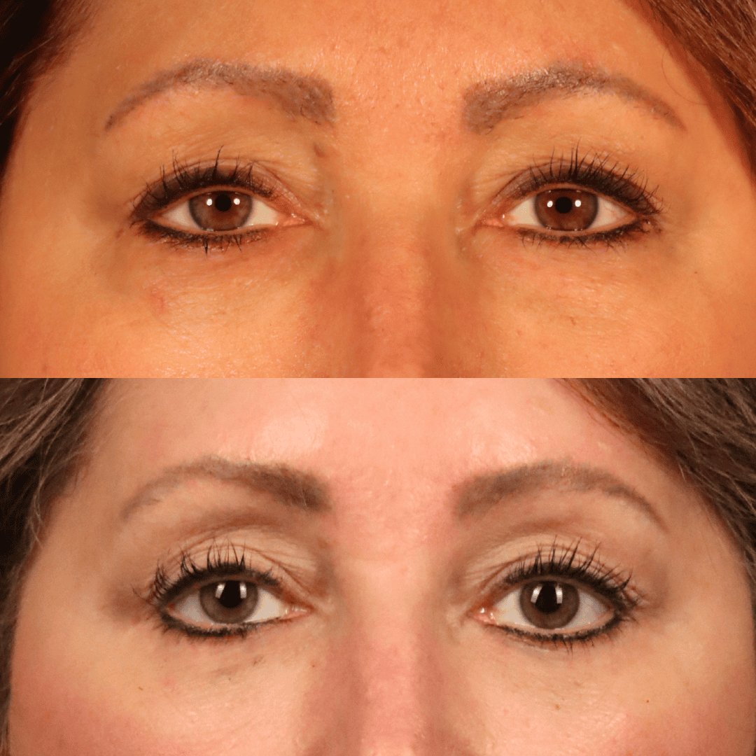 Before-and-after detail of the eye area after comprehensive facial rejuvenation.