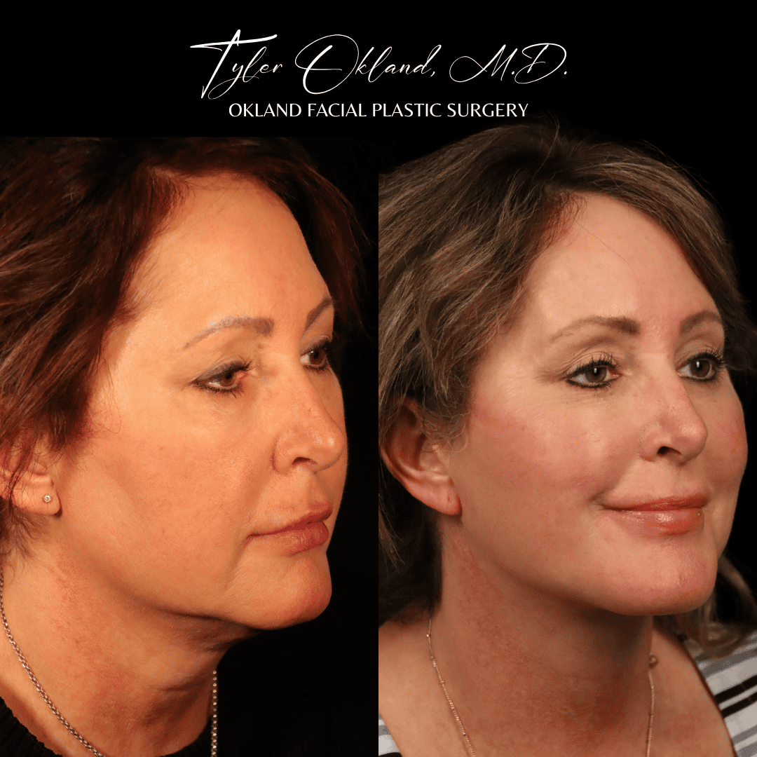 Three-quarter before-and-after result after comprehensive facial rejuvenation.