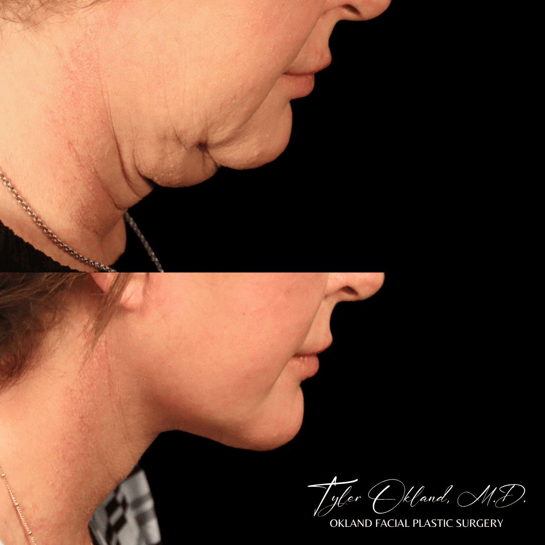 Before-and-after detail of the jawline and neck after comprehensive facial rejuvenation.