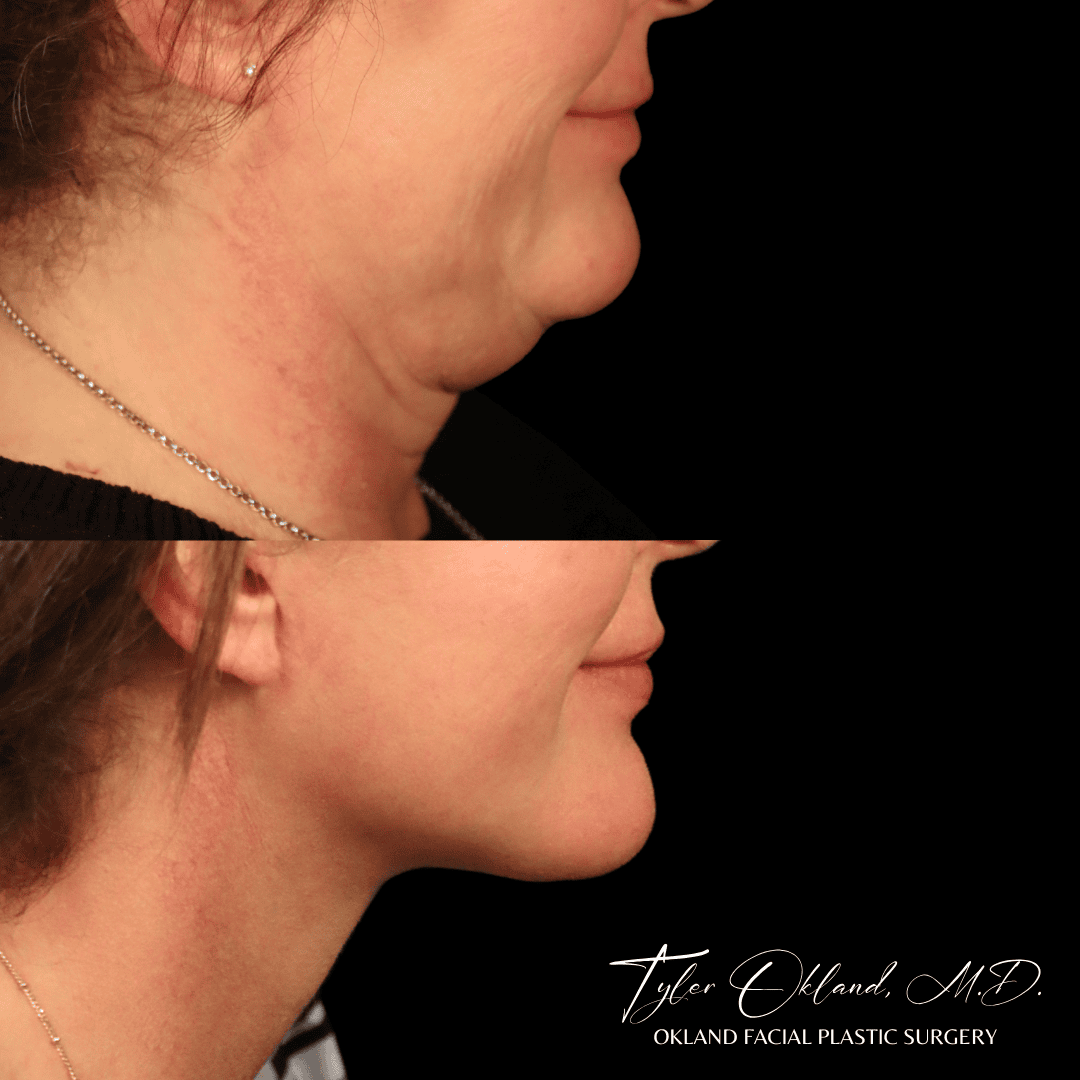 Before-and-after detail of the neck and jawline after comprehensive facial rejuvenation.