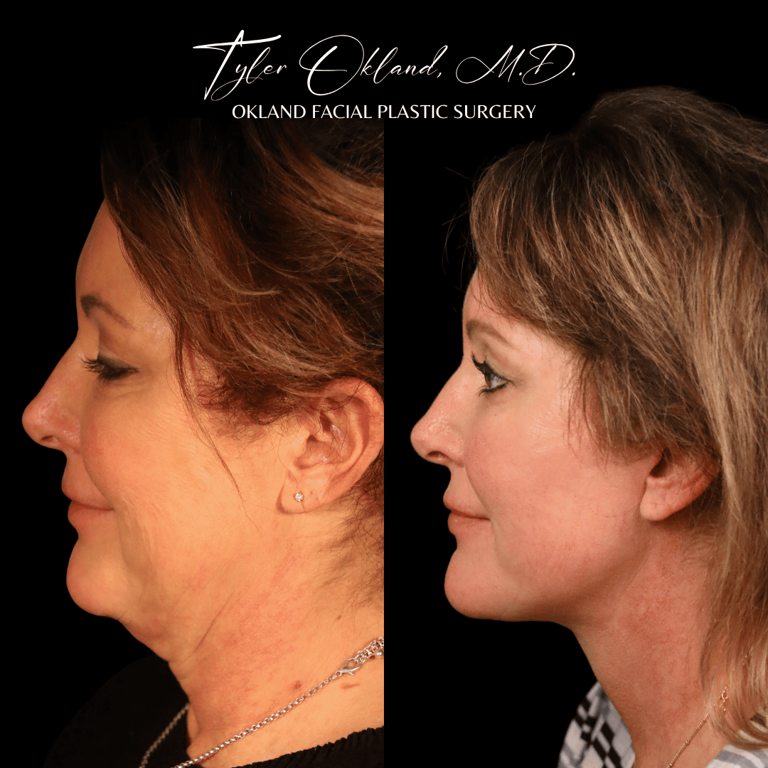 Opposite profile before-and-after result after comprehensive facial rejuvenation.