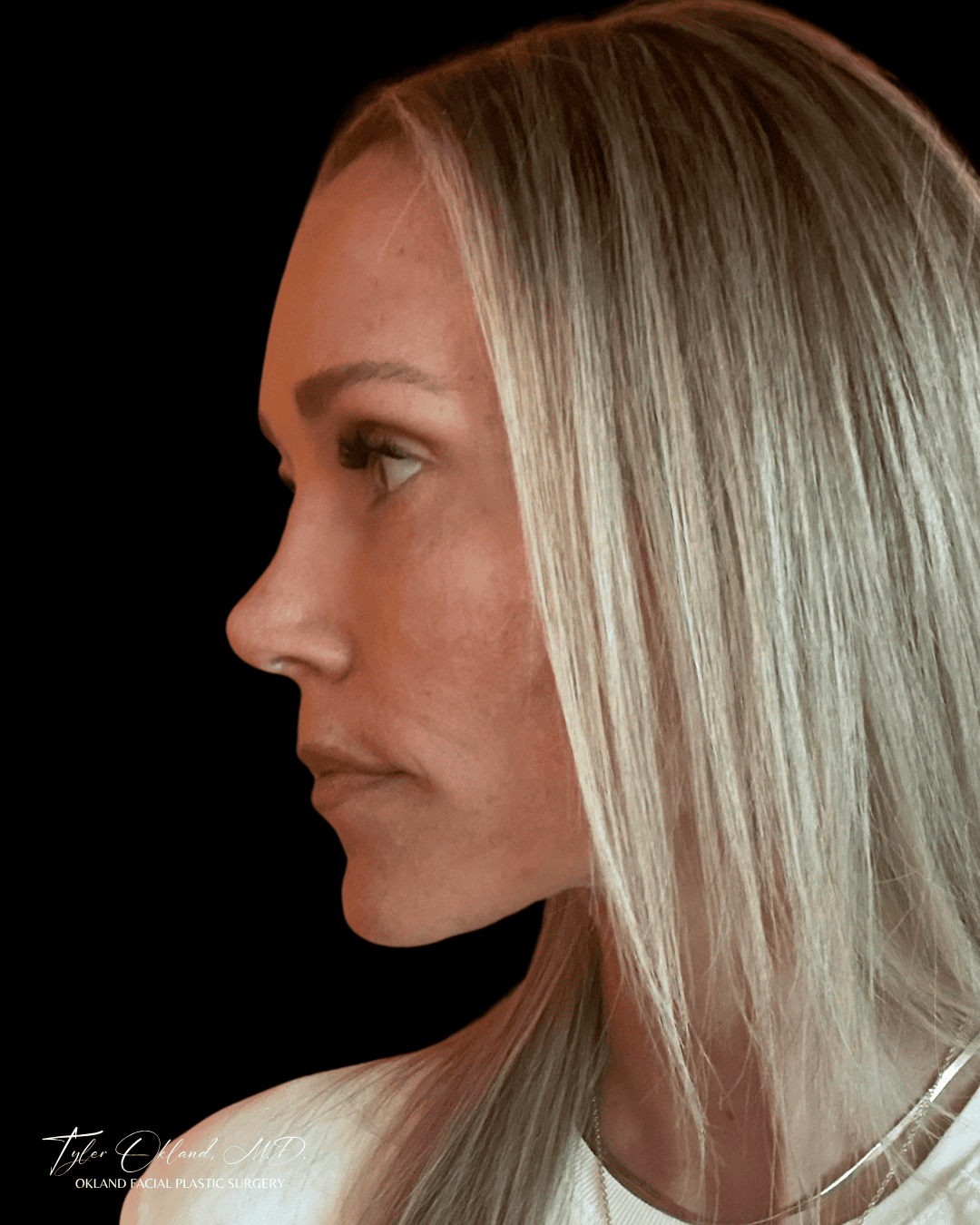 After view of a facelift patient from the left profile.