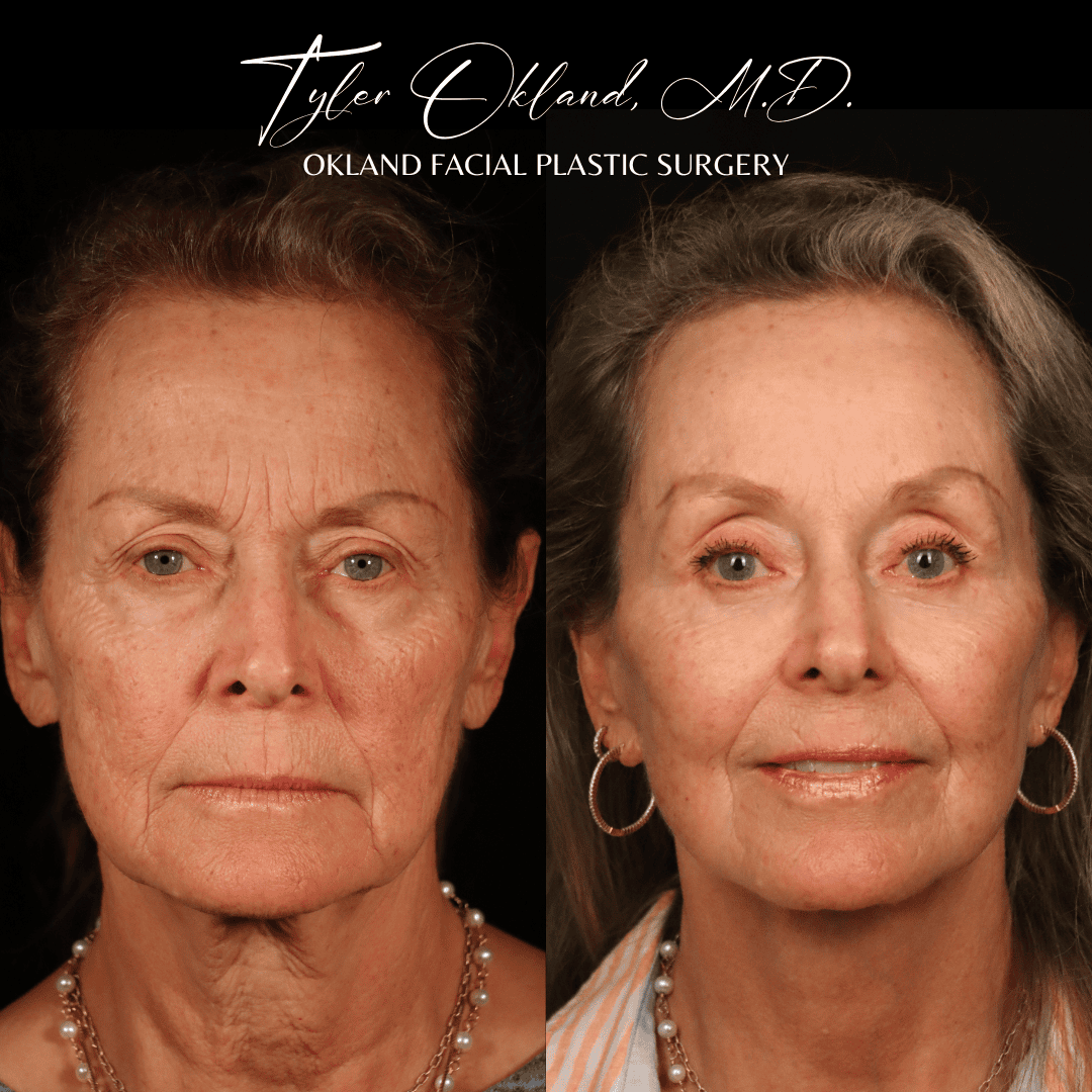 Frontal before-and-after result eight months after comprehensive facial rejuvenation.