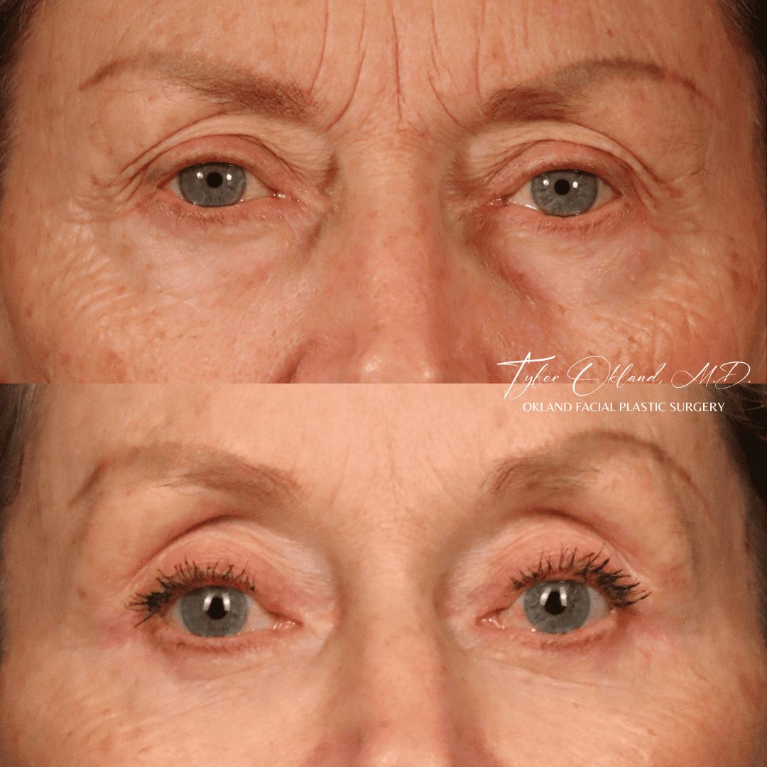 Before-and-after detail of the eye area after comprehensive facial rejuvenation.