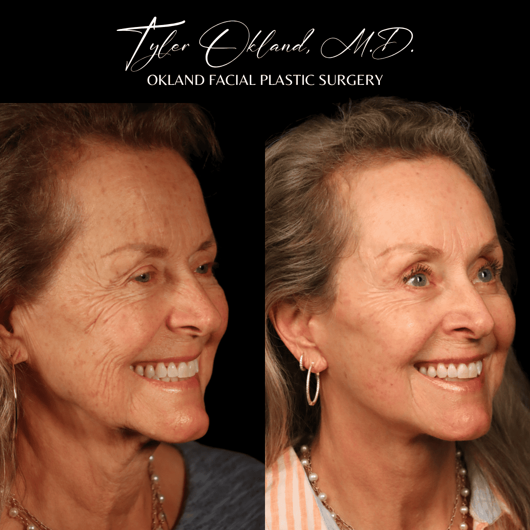Three-quarter smiling before-and-after result after comprehensive facial rejuvenation.