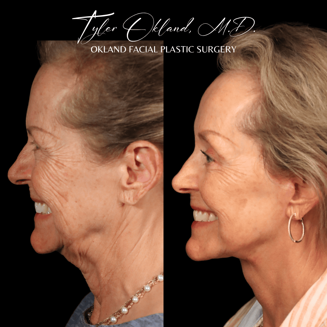 Profile before-and-after comparison after comprehensive facial rejuvenation.