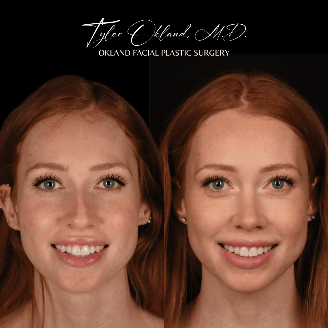 Primary rhinoplasty before and after case 2 by Dr. Tyler Okland