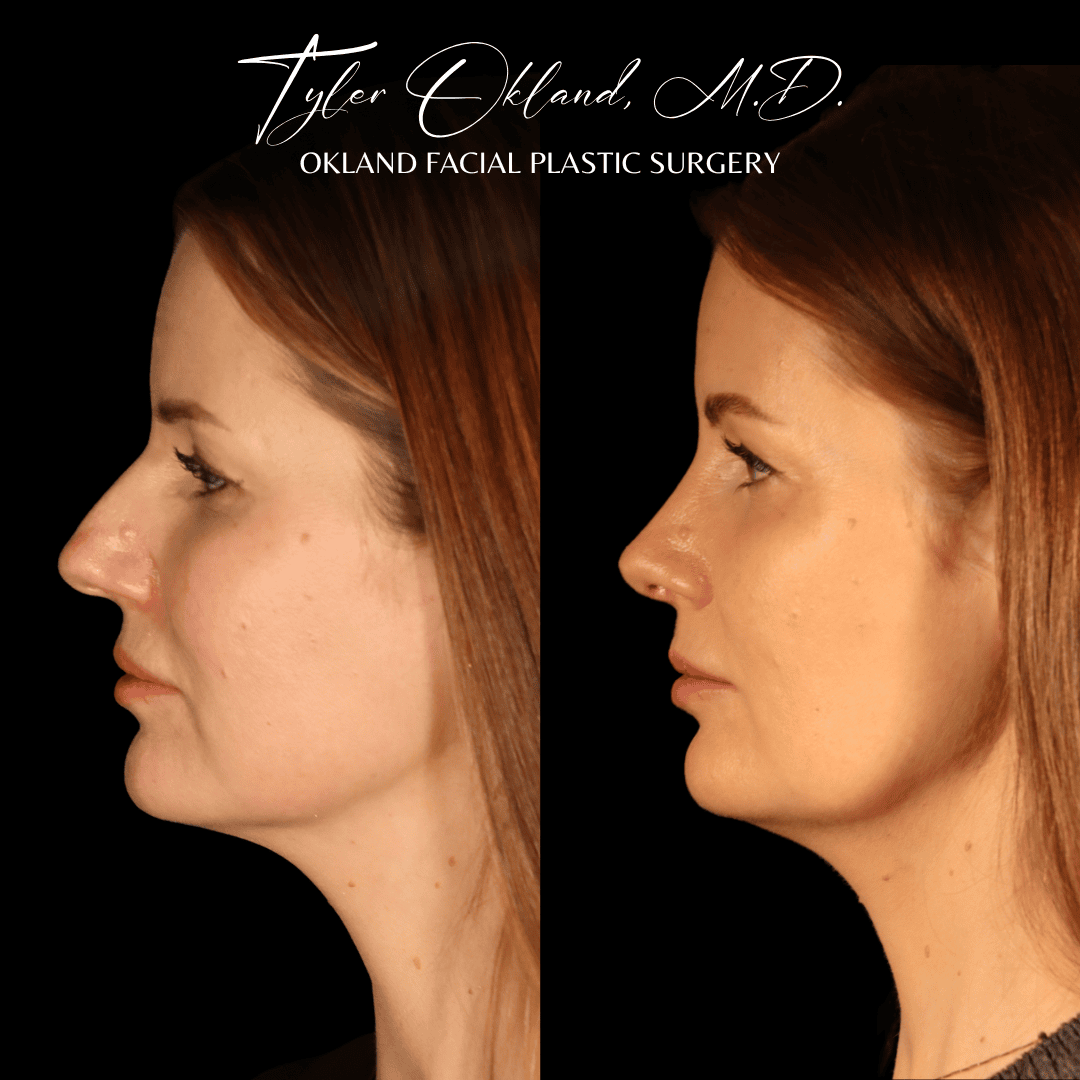 Primary rhinoplasty before and after case 3 by Dr. Tyler Okland