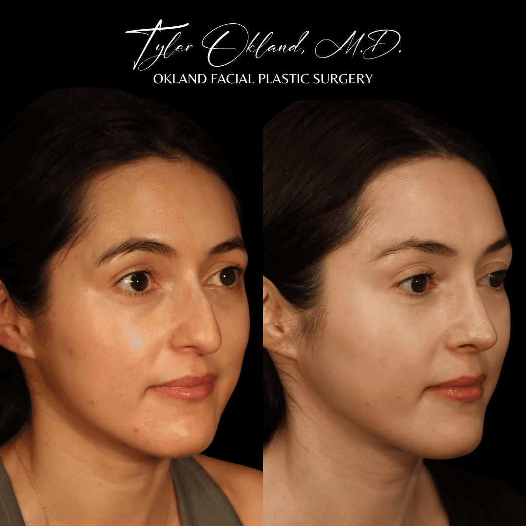 Primary rhinoplasty before and after case 4 by Dr. Tyler Okland