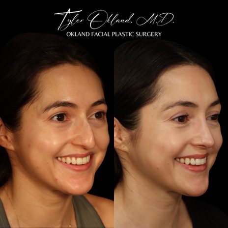 Case 01 matched smiling three-quarter view