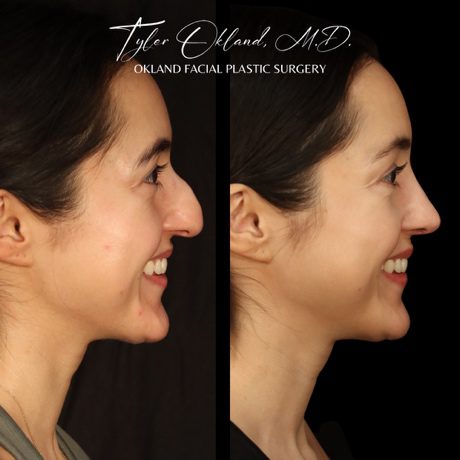 Case 01 matched smiling profile view