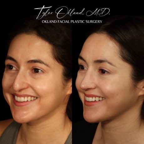 Case 01 matched opposite smiling three-quarter view