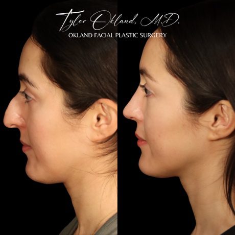Case 01 matched opposite profile view