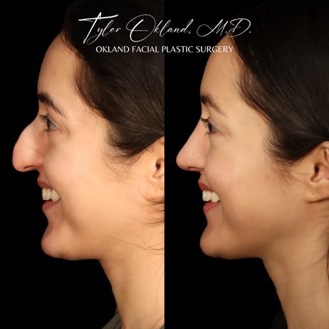 Case 01 matched opposite smiling profile view