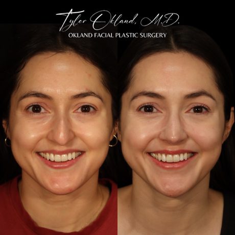 Case 01 matched smiling frontal view