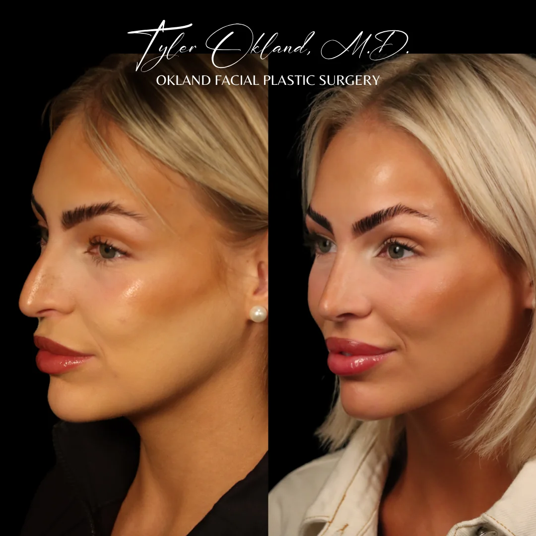 Primary rhinoplasty before and after by Dr. Tyler Okland