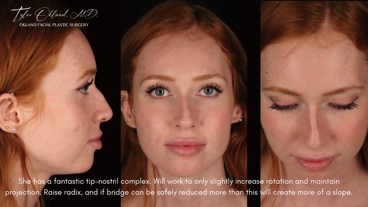 Case 02 rhinoplasty clinical photograph