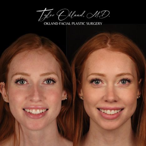 Case 02 matched smiling frontal view