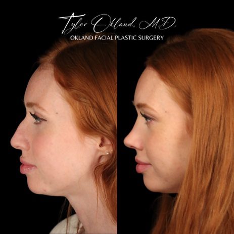 Case 02 matched opposite profile view