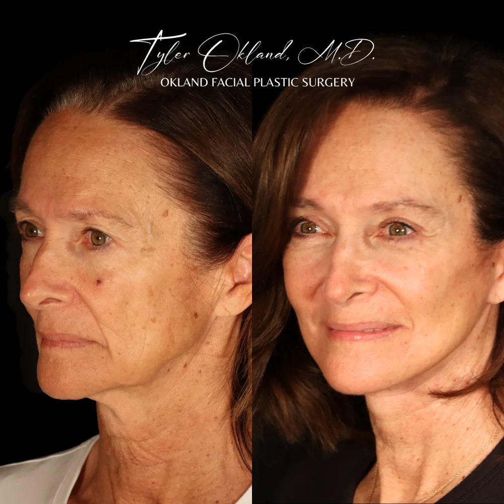 Deep plane facelift before and after three-quarter view by Dr. Tyler Okland in Denver