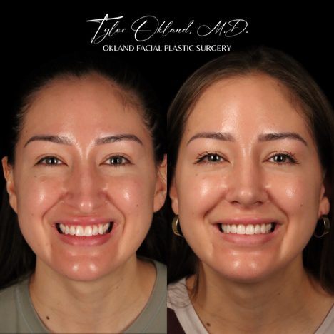 Case 03 matched smiling frontal view