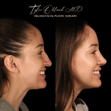 Case 03 matched smiling profile view