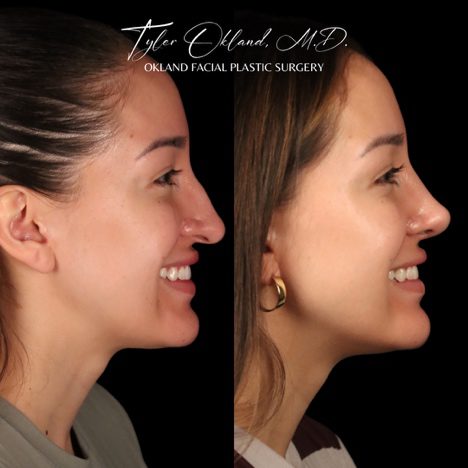 Case 03 matched opposite smiling profile view