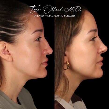 Case 03 matched opposite profile repose view