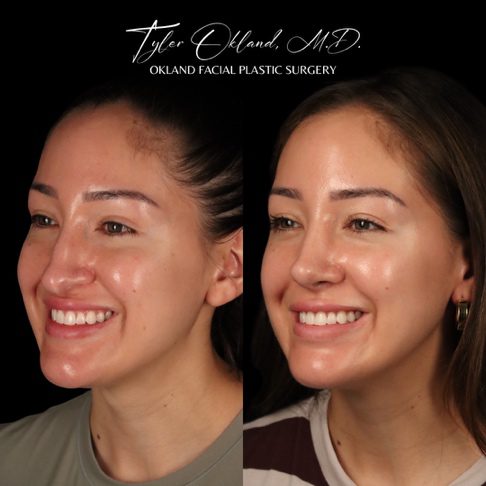 Case 03 matched smiling three-quarter view