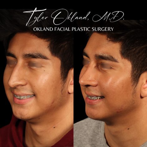 Case 04 matched smiling three-quarter view