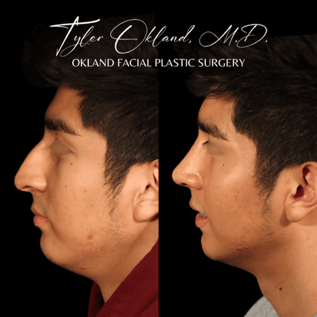 Case 04 matched opposite profile view