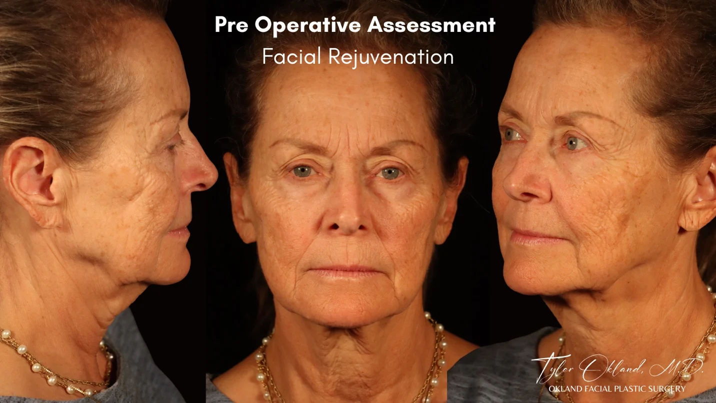 Preoperative facial assessment for deep plane facelift case study 1.