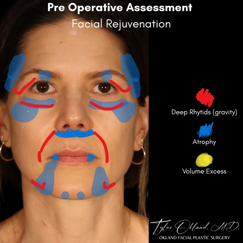 Diagnostic facial overlay for deep plane facelift case study 2.