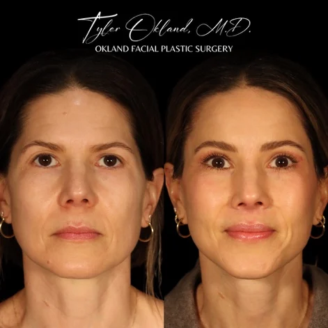 Frontal before-and-after result after comprehensive facial rejuvenation.
