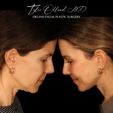 Neck flexion before-and-after result after facial rejuvenation.