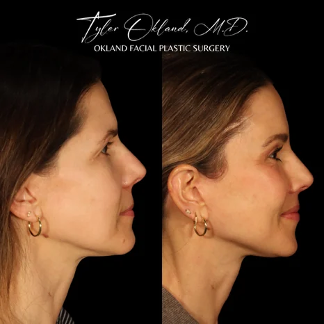 Profile before-and-after result after comprehensive facial rejuvenation.