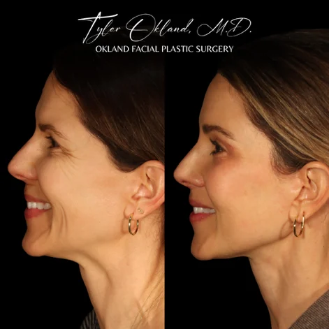 Smiling profile and three-quarter before-and-after result after facial rejuvenation.