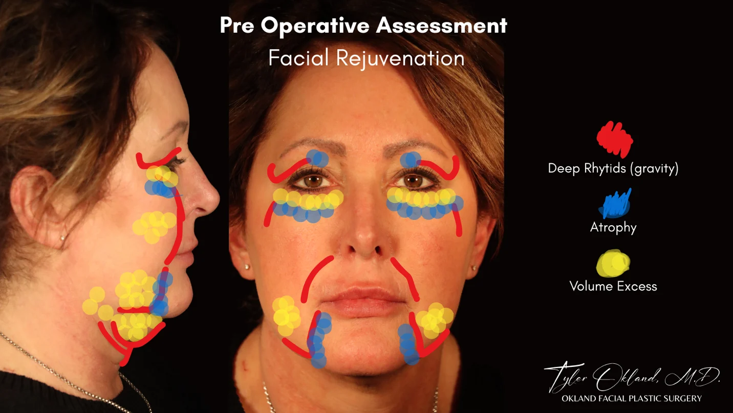 Diagnostic facial overlay for deep plane facelift case study 3.