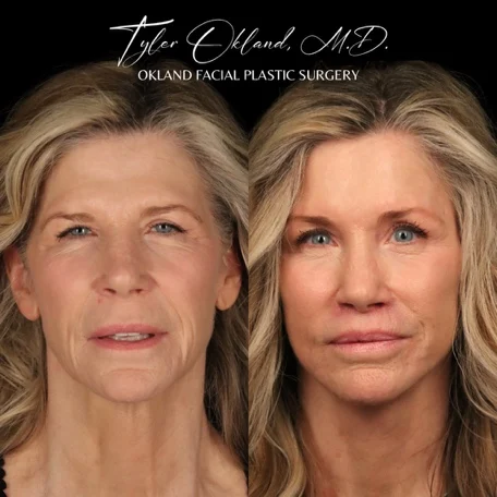 Frontal before-and-after result four months after comprehensive facial rejuvenation.