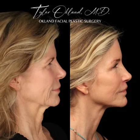 Opposite profile before-and-after comparison after comprehensive facial rejuvenation.
